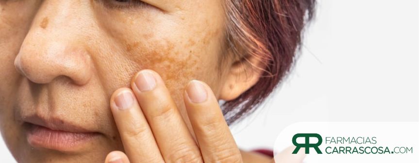 tipos de manchas en la cara y causas: una consulta común en Farmacias Carrascosa
